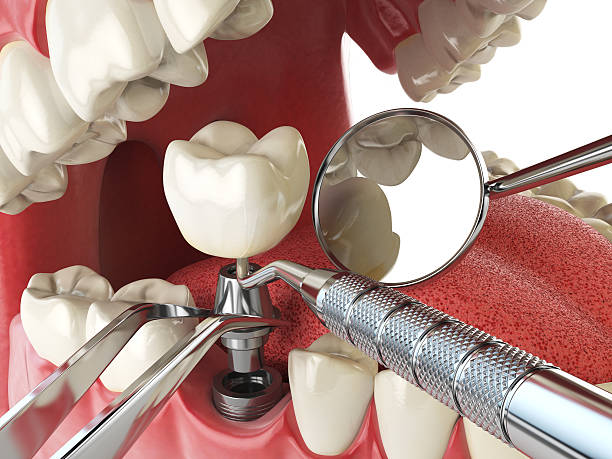 Best Emergency Root Canal Treatment in Brookfield Center, OH