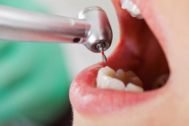 Best Emergency Tooth Extraction in Brookfield Center, OH